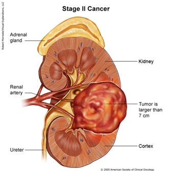 File:Kidneycancerstage2b.jpg