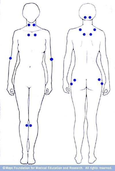 File:Fibromyalgia Pain Chart.JPG