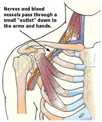 The Subclavius Muscle - The Single Most Super Contracted Muscle of Thoracic  Outlet Syndrome - Thoracic Outlet Syndrome