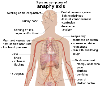 "File:Signs and symptoms of anaphylaxis.png" by Mikael Häggström is marked with CC0 1.0.