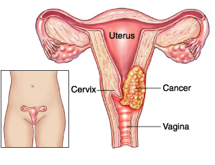 File:Cervical-cancer.jpg