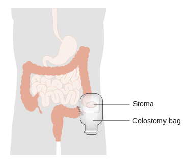 File:Colostomy.png