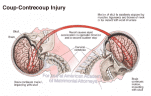 File:Coup-contrecoup Injury.png