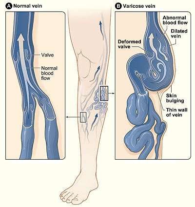 Understanding Chronic Venous Insufficiency: Causes, Symptoms, and Risk  Factors - Advanced Heart and Vascular Institute