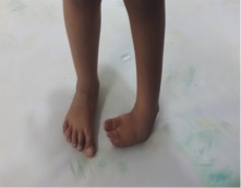 Case Study Clubfoot with Post-surgical Relapse - Before.jpg