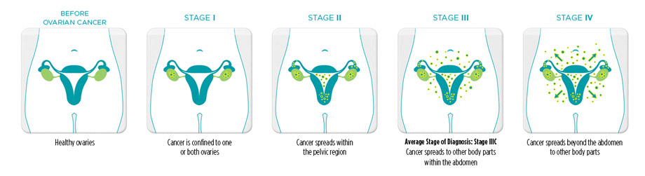 Stages cancer.jpg