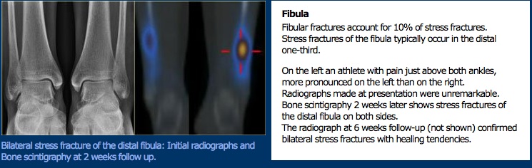 File:Bone Scan Distal Fibula.jpg