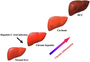 Progression of Hepatitis C effects on the liver.