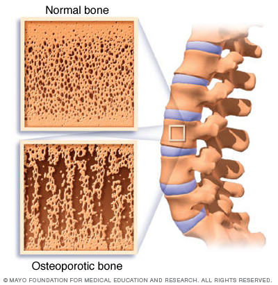 File:Mcdc7 osteoporosis compare.jpg