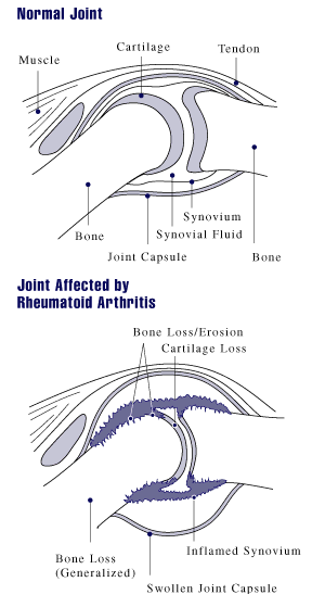 File:Rheumatoid arthritis joint.gif