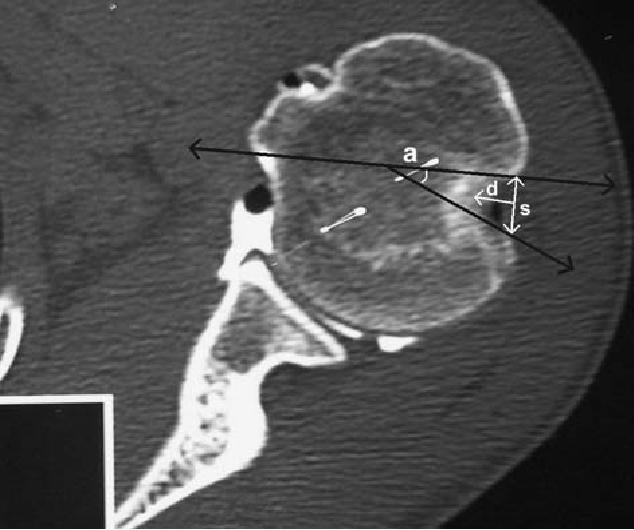 Figure 1: preoperative double contrast CT arthrography of a 20 year old patient