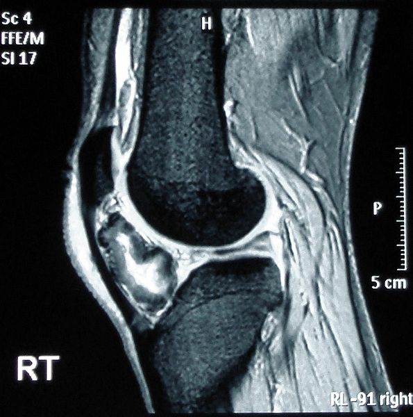 File:Osteochondroma MRI.JPEG