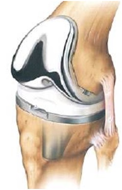 File:Total knee arthroplasty.jpg