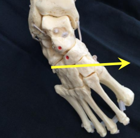 File:Clubfoot-adductus.png