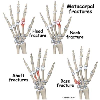 5th metacarpal fracture symptoms