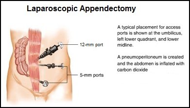 Laparoscopic surgery uses smaller incisions and special surgical tools.Image From: http://www.zadehsurgical.com/general-surgery-services-encino/appendicitis/