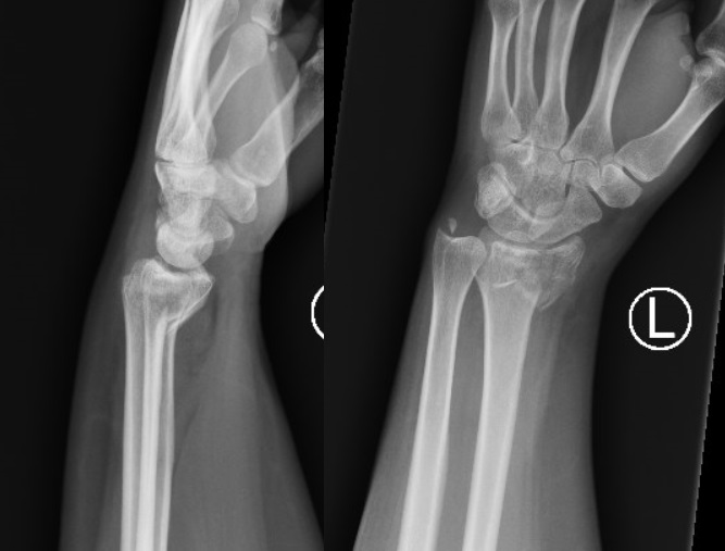 File:Smiths Fracture.jpg