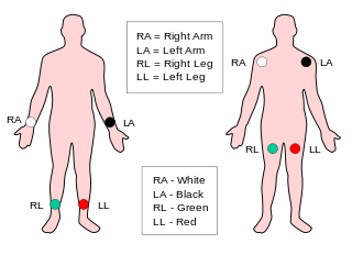 File:Limb leads placement.png