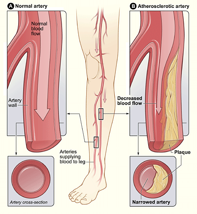 The illustration shows how P.A.D. can affect arteries in the legs. Figure A shows a normal artery with normal blood flow. The inset image shows a cross-section of the normal artery. Figure B shows an artery with plaque buildup that's partially blocking blood flow. The inset image shows a cross-section of the narrowed artery.