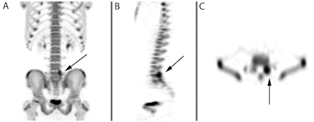 File:Spondylolysis SPEC image (1).docx.jpg