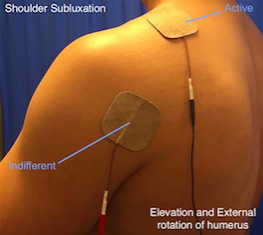 Electrical Stimulation for Shoulder Pain - Help What Hurts