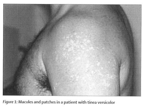 Tinea versicolor caused by Malassezia furfur infection and laboratory  diagnosis