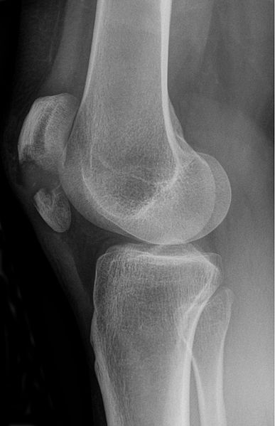 File:Patella fracture latview.jpg