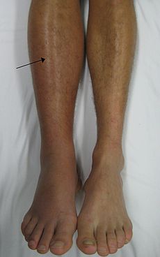 DVT in the right leg with swelling and redness