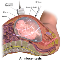 File:Amniocentesis.png