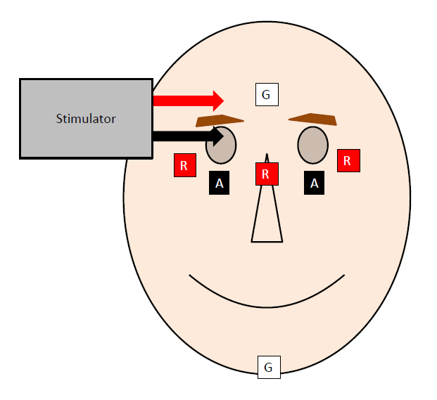 File:Blink reflex - Electrode placement.png