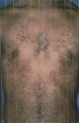 Tinea versicolor on the trunk of a dark skinned patient.