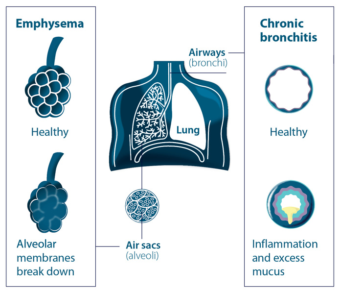 File:Copd-diagram-of-lungs-blf-695.jpg