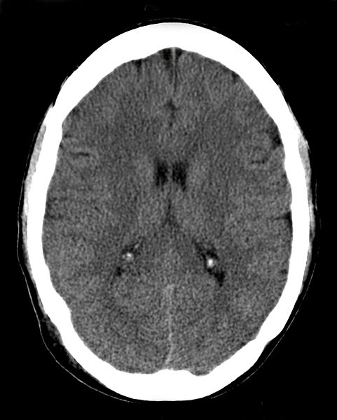 File:CT scan brain.jpg