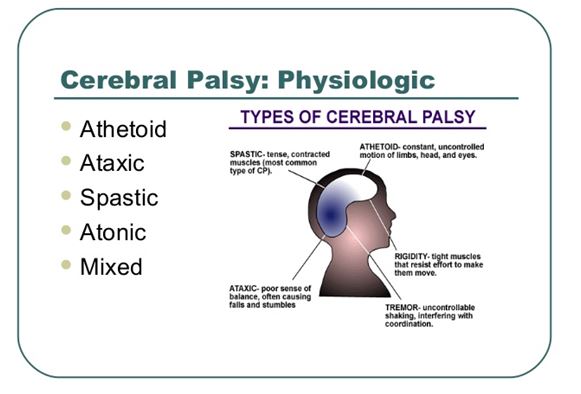 Athetoid Cerebral Palsy
