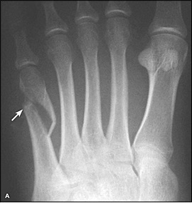 5th metatarsal fracture not healing