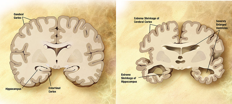 File:Alzheimer's disease brain comparison.jpg