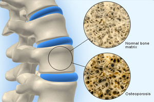 Picture to show normal and osteoporotic bone
