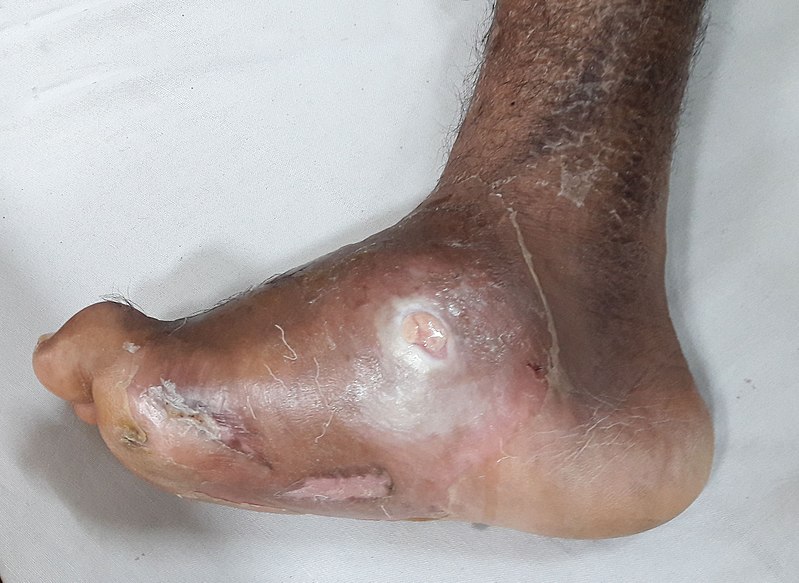File:Diabetic Charcot Foot Deformity.jpg