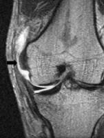 osteoarthritis knee mri