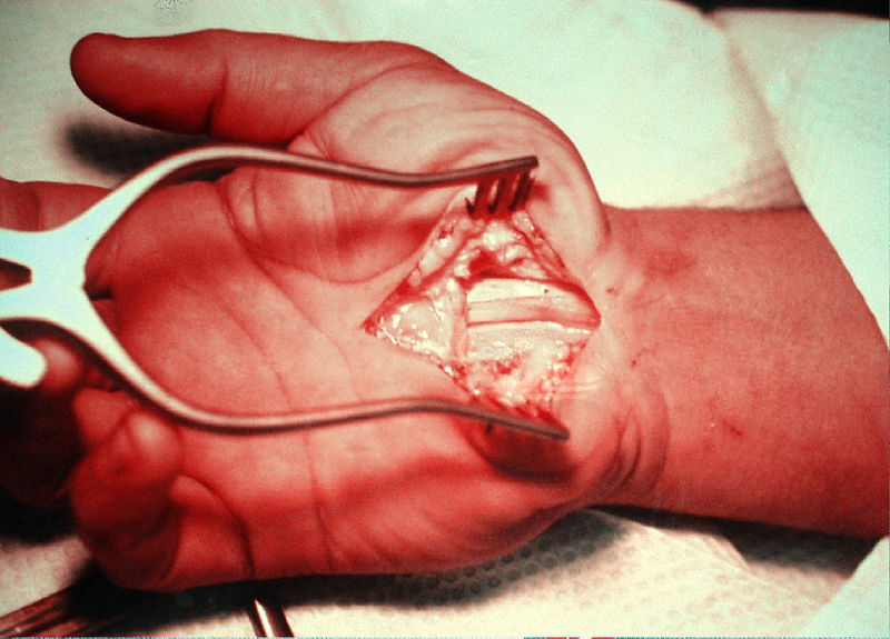 File:Carpal Tunnel Syndrome Operation.jpg