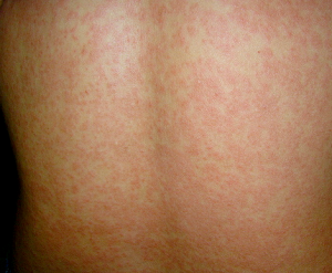 chikungunya rashes