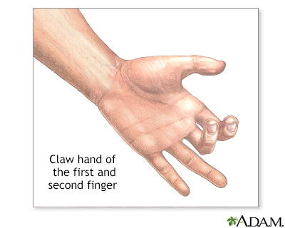 File:Claw hand.jpg