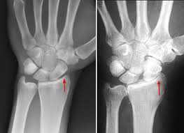 X-ray of Wrist arthritis.jpeg