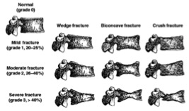 File:Type of fractures.jpg