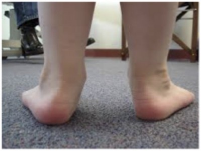 File:Pronated-Kids-Feet-400x301 (1).jpg