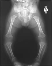 achondroplasia x ray vs normal