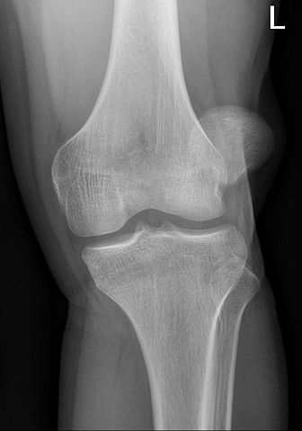 lateral knee dislocation