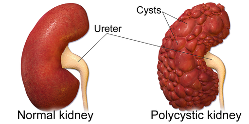 File:Polycystic Kidney 512px.png