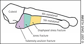 5th metatarsal fracture physical therapy