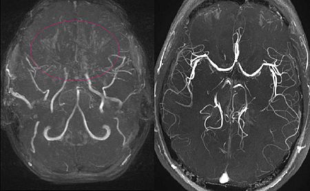 2 images, both MIP reconstructed MR angiographies; one is that of an 11 year old girl with Moyamoya Disease, which shows the characteristic occluded cranial arteries, and the other image shows a healthy subject for comparison.
